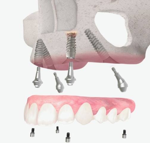 Full arch dental implants in Long Island at the Farber Center for Periodontics and Dental Implants, Suffolk County New York permanent dentures..