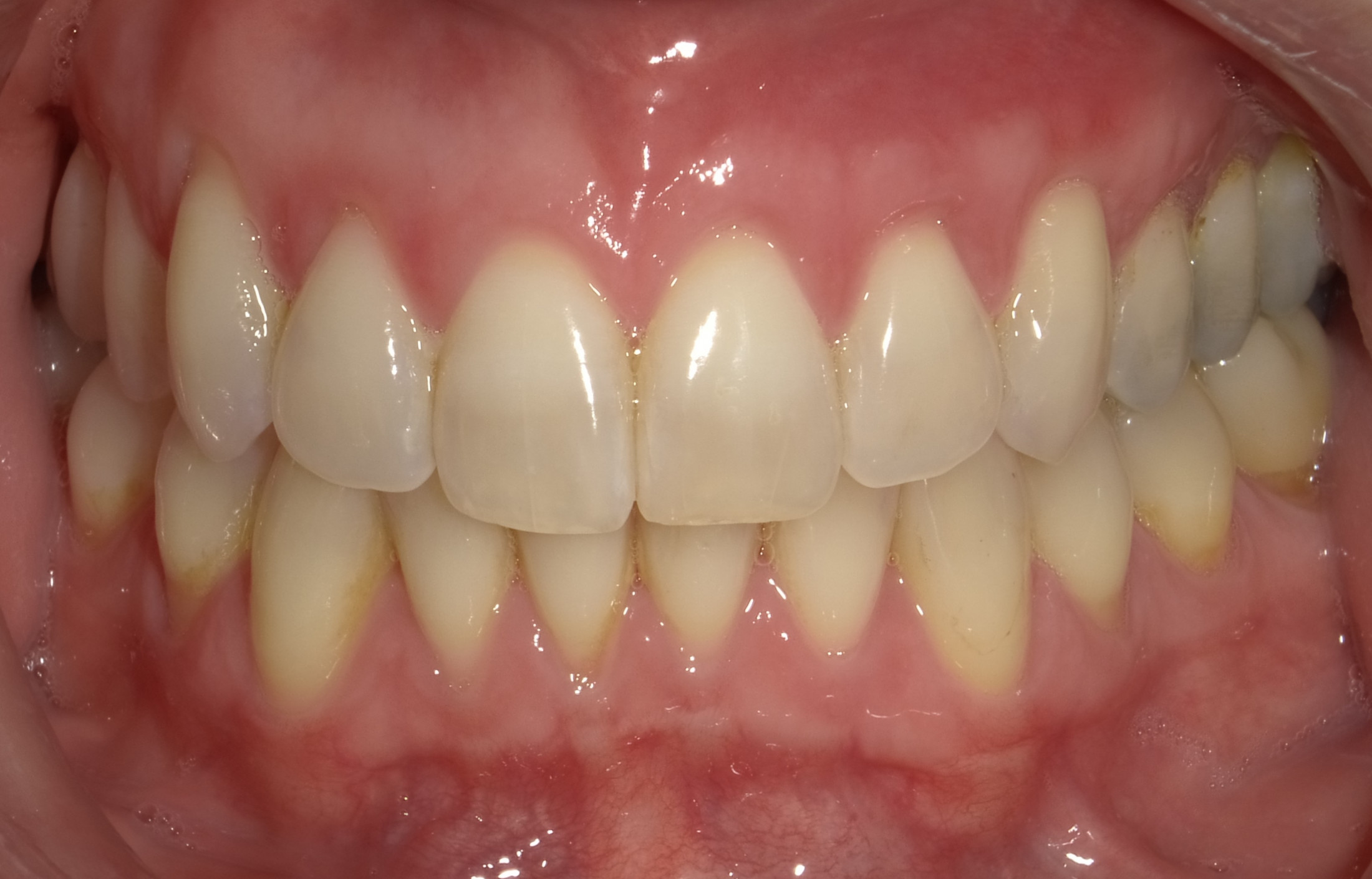 After Soft Tissue Graft