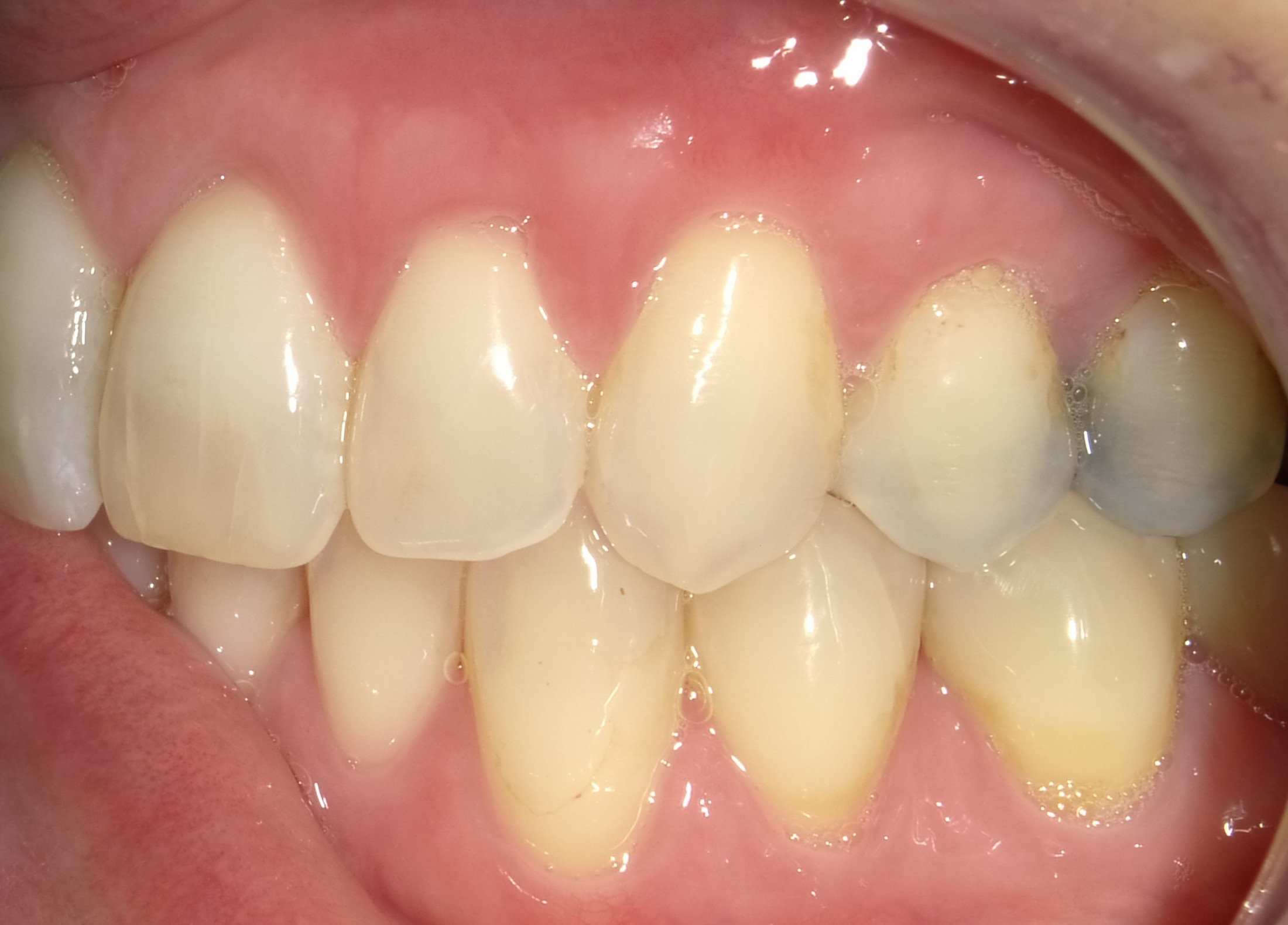 After Soft Tissue Graft