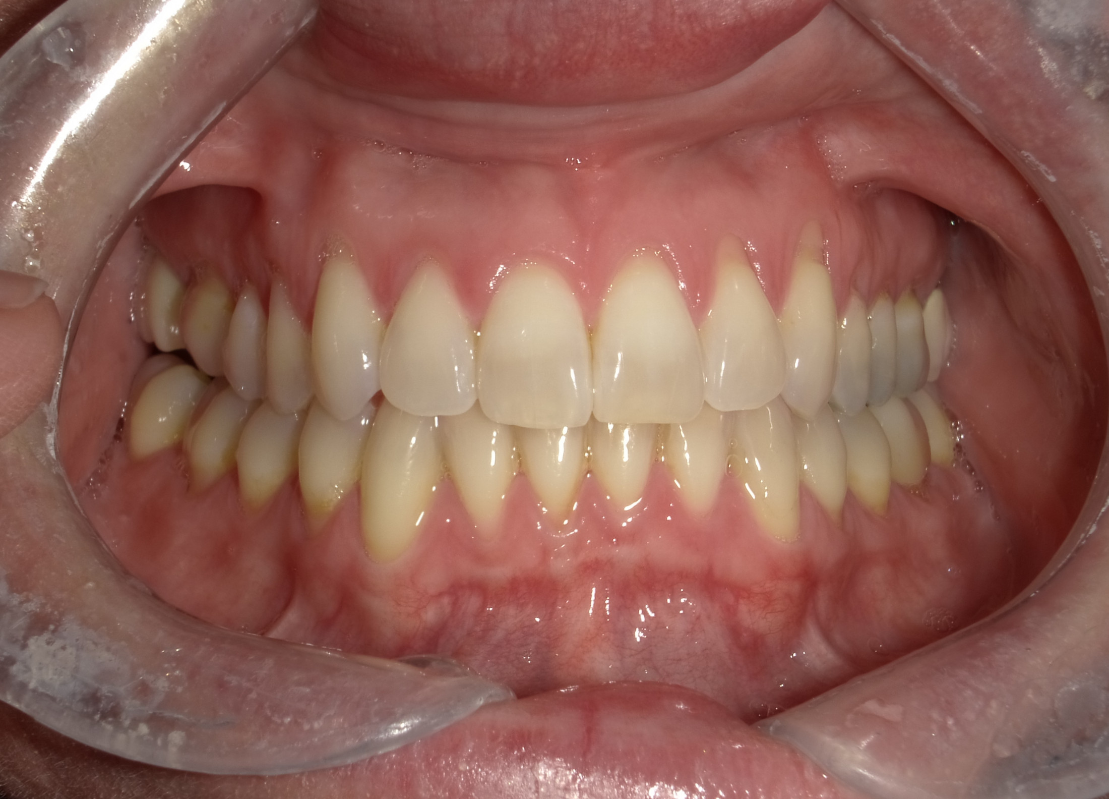 Before Soft Tissue Graft