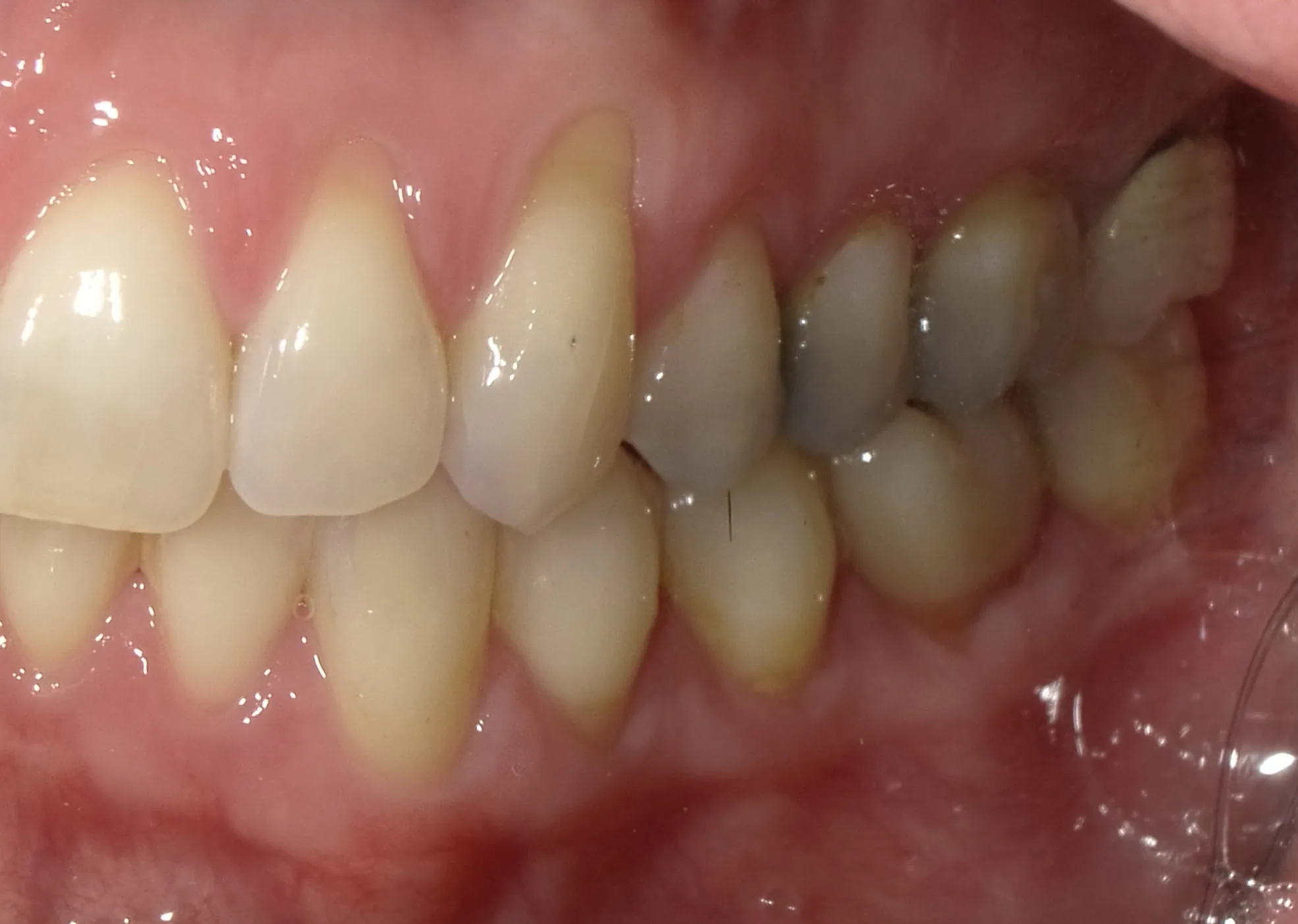 Before Soft Tissue Graft