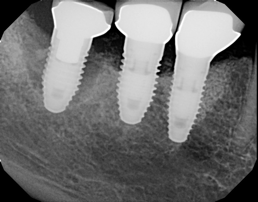 lapip case three before