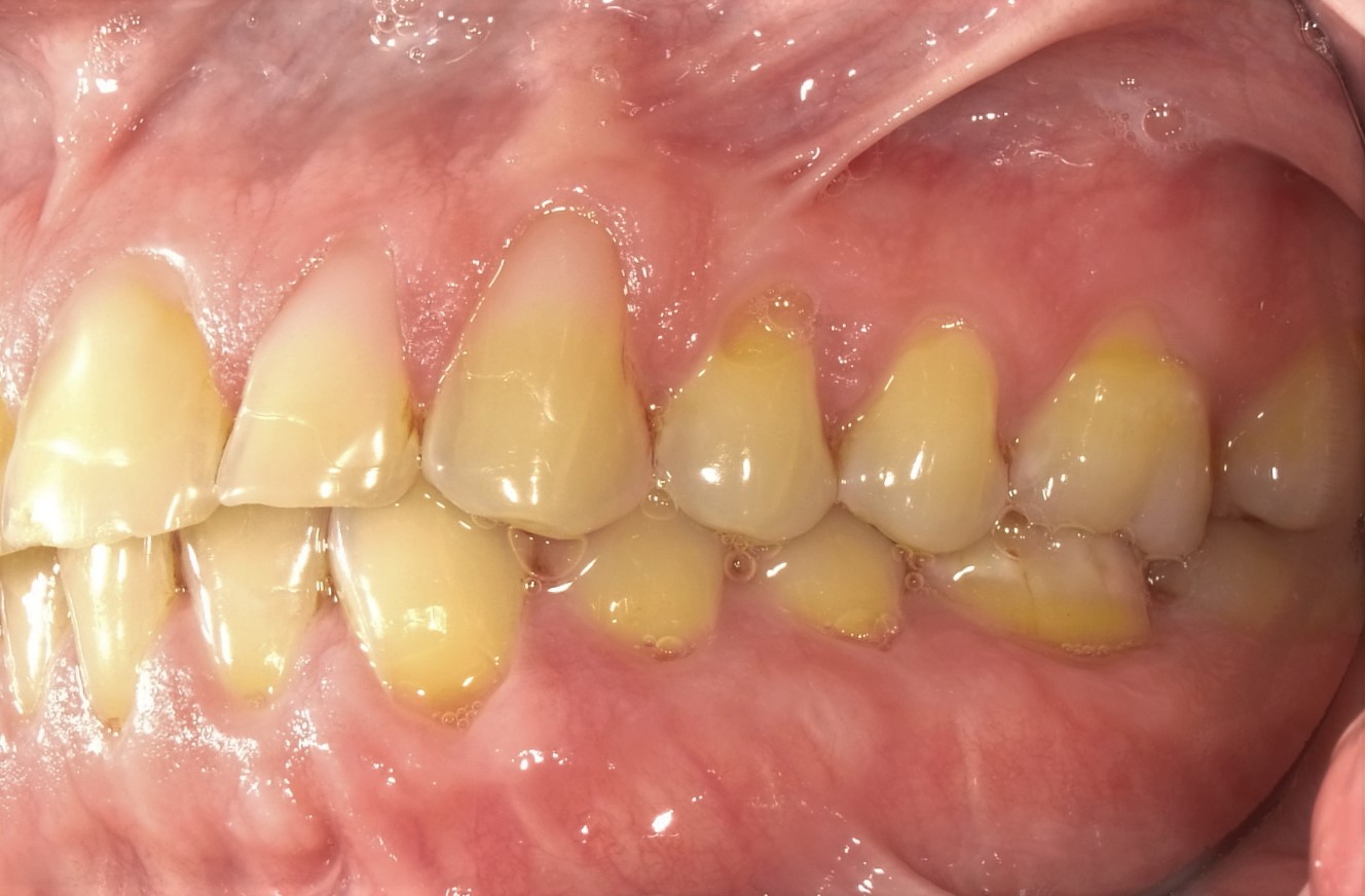 After Treatment STG