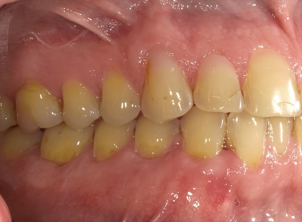 After Treatment Soft Tissue Graft