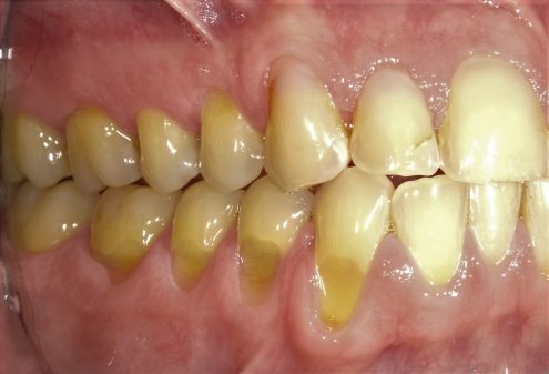 Before Treatment Soft Tissue Graft