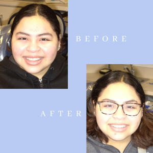 Before & After Crown Lengthening