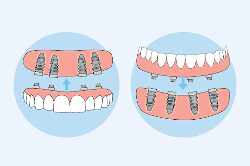all-on-4 dental implants