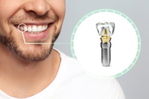 man with single tooth dental implant