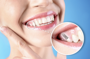 woman with single tooth dental implant