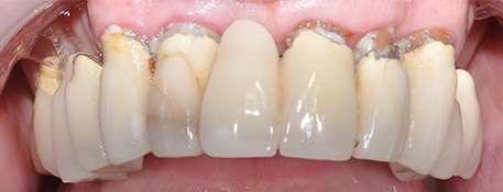 Before Upper Arch All-on-4