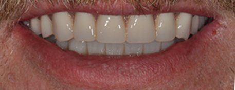 After Full Mouth Restoration (Facial)