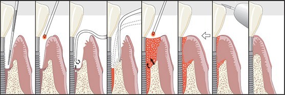 Laser gum surgery Long Island LANAP. The LANAP protocol for periodontitis