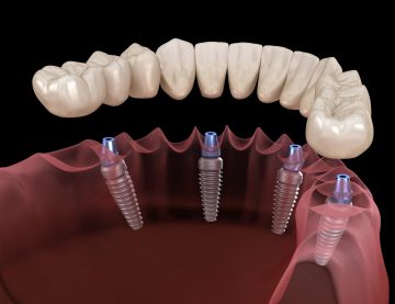 Computer-guided dental implants being placed in Long Island, with dentist offices in Hauppage and Medford, NY.
