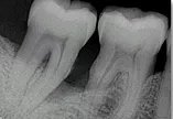 hopeless tooth