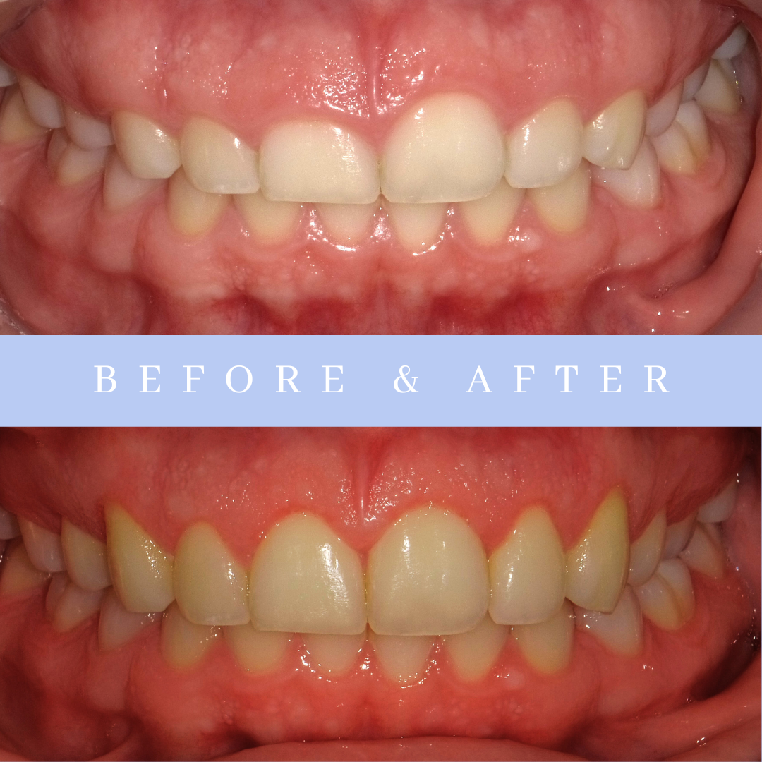 Crown Lengthening Before & After